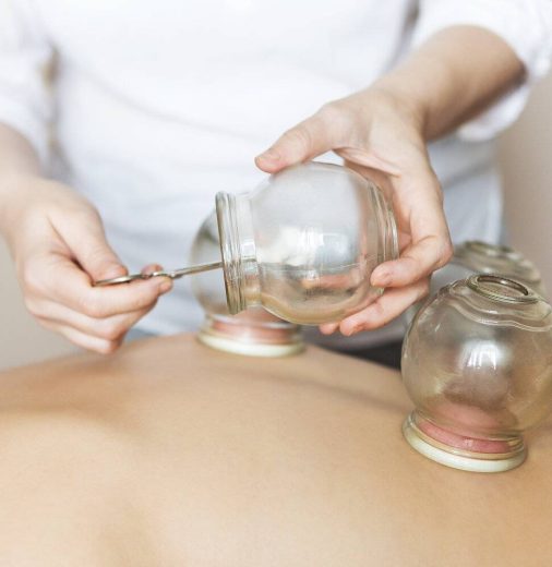 Young woman getting treatment at medical clinic. Fire cupping cups on back of female patient in Acupuncture therapy